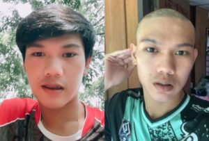 pelajar-d4kwa-jadi-botak-selepas-ambil-vaksln-sinovac_6197ca7d70995
